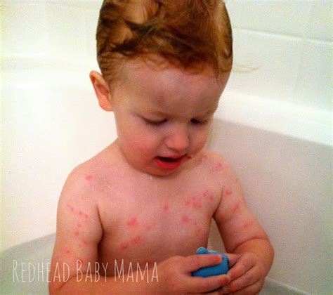 Fortunately, most babies outgrow milk allergies by their second or third year. What Allergic-Reaction Hives Look Like - Redhead Baby Mama ...