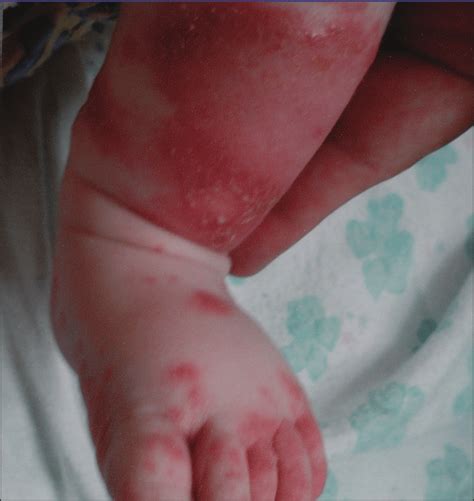 Pustular Skin Lesions In Dira Reprinted With Permission From Henderson