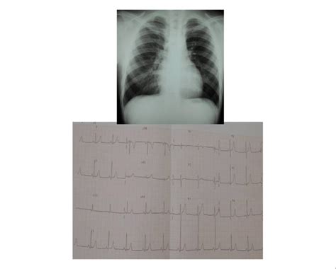 Posteroanterior Chest Radiography Showing Normal Heart Area And
