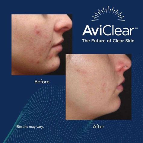 Aviclear The Best Acne Treatment