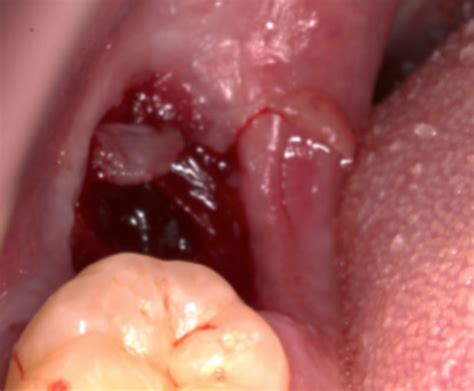 A Bleeding Socket After Tooth Extraction The Bmj