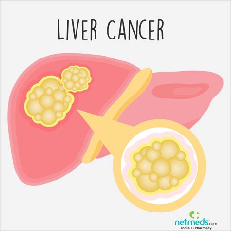 Adult Primary Liver Cancer As Related To Liver Cancer Pictures