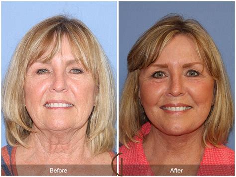 Having Performed Over 3500 Facelifts Throughout His Career This Facelift Before And After Gallery