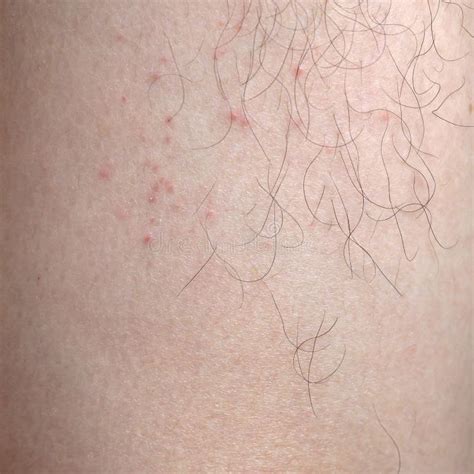 Rash On Sensitive Skin Stock Photo Image Of Close Texture 97261748