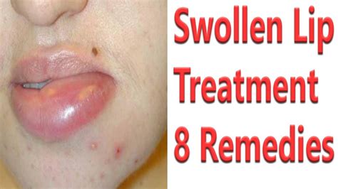 8 Best Remedies For Swollen Lip Treatment How To Get Rid Of Swollen Lips Fast Youtube