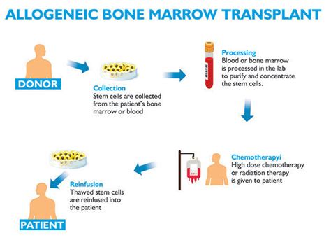 Why Is Bone Marrow Transplant Done Clinicspots