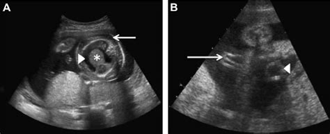 Fetal Ultrasound Of Right Sided Congenital Diaphragmatic Hernia Cdh
