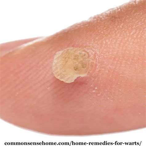 15 Home Remedies For Warts Easy Home Wart Treatments