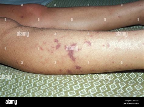 Purpuric Rash On Lower Legs In Meningococcal Septicaemia In Young Stock