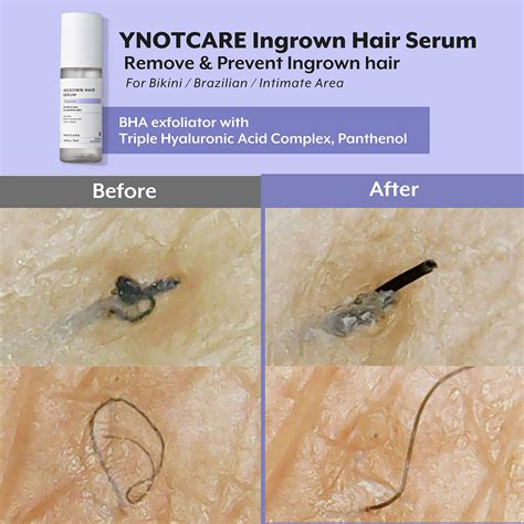 Top More Than 67 Ingrown Hair Pubic Area Latest In Eteachers