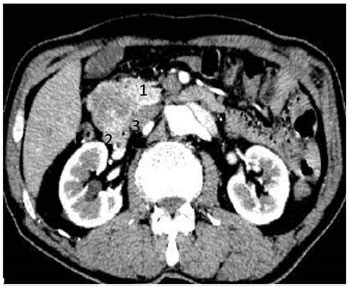 Case Report Of Duodenal Gastrointestinal Stromal Tumor Masquerading A