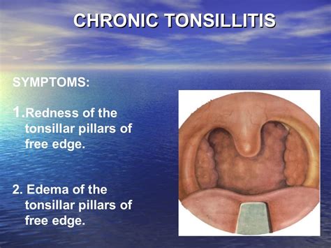 Anatomy Of Tonsillitis Anatomy Diagram Source Images And Photos Finder