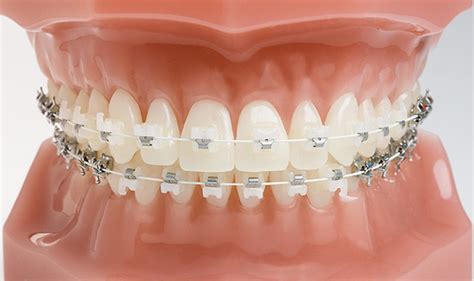 Ceramic Braces Burnie The Orthodontic Specialists Devonport Launceston Invisible Orthodontics