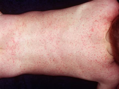 Childhood Rashes Skin Conditions And Infections Photos Babycentre