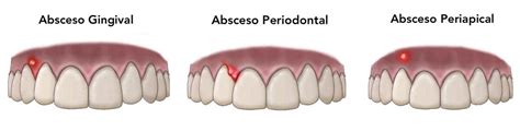 Absceso Dental Tratamiento Y Causas Clinica Dental Palomero