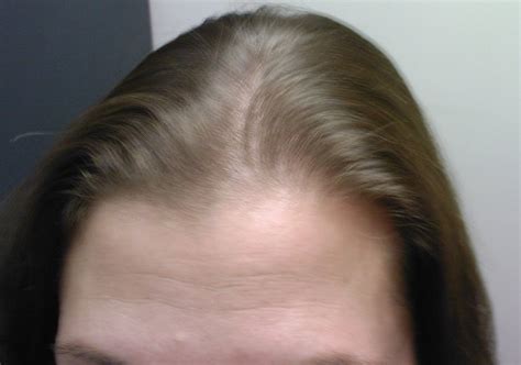 The Hair Loss Centre FEMALE HAIR LOSS