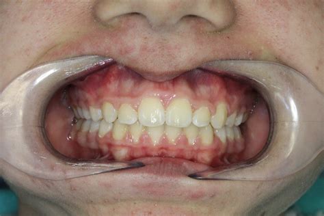 What Is A Tongue Thrust Habit Align Dentistry Blog Call 02 9723 5757