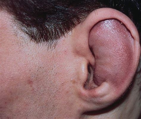 External Ear Deformity Types Of Ear Deformities Brapp