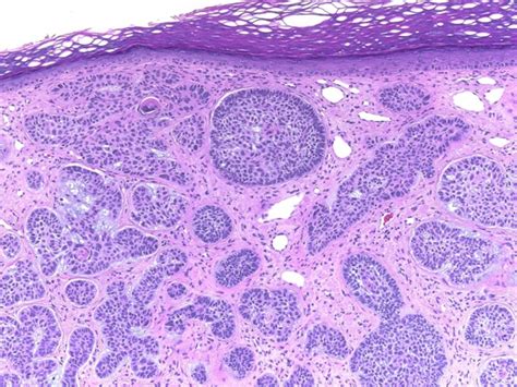 Basal cell carcinoma occurs when one of the skin's basal cells develops a mutation in its dna. Basal Cell Carcinoma of the Skin - Oncology - Medbullets ...