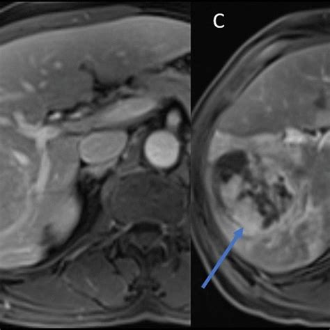 Axial Post Contrast T1 Weighted Fat Suppressed Arterial Phase Mr Image