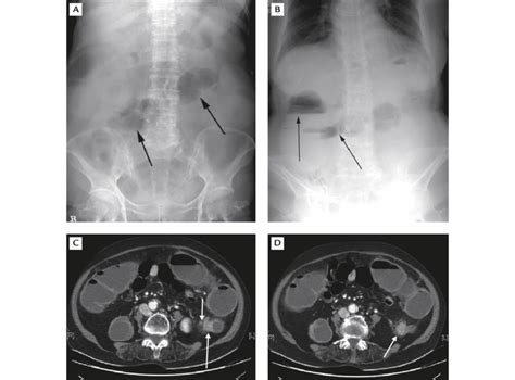 Simple Abdominal X Ray Flat A And Upright B View Of Descending