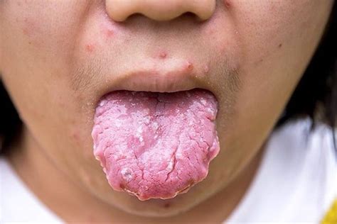 However, certain medications and health issues can cause more yeast multiply, especially candida albicans, resulting in a condition called candidiasis (a fungal infection caused by yeasts that belong to the genus candida). Nystatin Pills For Yeast Infection - Nystatin Tablets