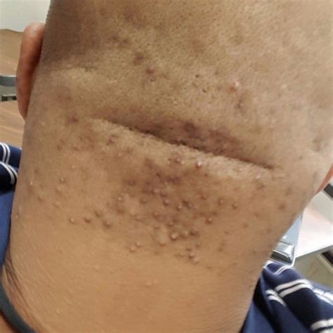 Most often, hair that is shaved, waxed, or plucked will grow back through the skin and toward the surface. Tend Skin Solution for showing ingrown hairs and razor ...