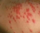 Images of Rash From Hot Tub