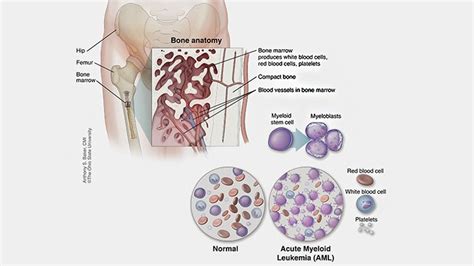 What Is Acute Myeloid Leukemia Aml Cancer Refractory And Relapsed