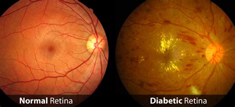 Diagnosing diabetic eye disease how diabetes affects the eyes and vision: Diabetic Retinopathy - Dallas, TX | Saland Vision