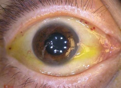 health talk eyes has become yellowish?color of urine dark brown ?! Eye Discoloration Causes, Yellowing Eye Whites, Under ...