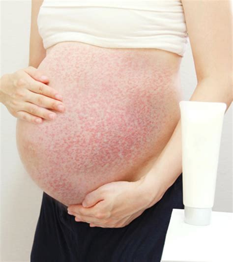 Shingles During Pregnancy Treatment Pregnancywalls