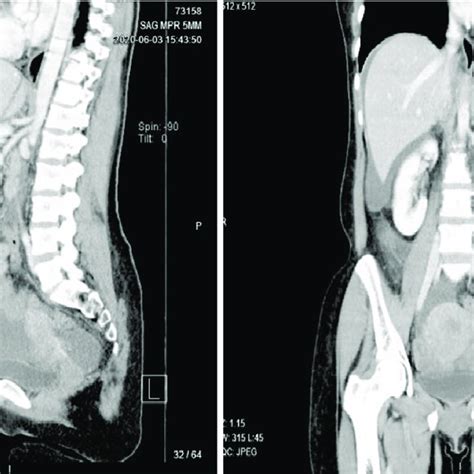 Computed Tomography Showing A Complex Cystic Mass Arising From Left