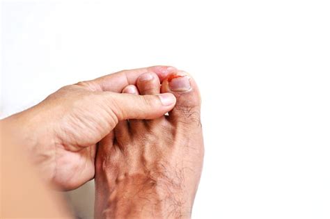 Figure Out The Nail Accident Nail Trauma Bleeding Toe Nails Foot Ulcers