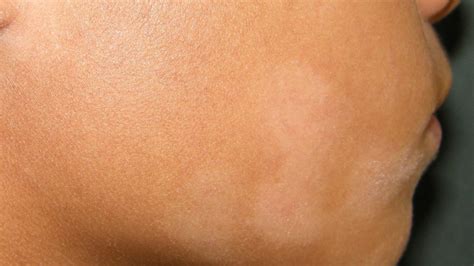 Hypopigmented Skin Lesions Healthgistnet