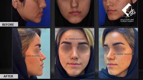 ٦ أفضل أنواع كريمات الأساس. دكتور كريم جلائيان جراحة تجميل الانف صور قبل وبعد / شركة ...