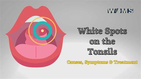 White Spots On The Tonsils Causes Symptoms And Treatment