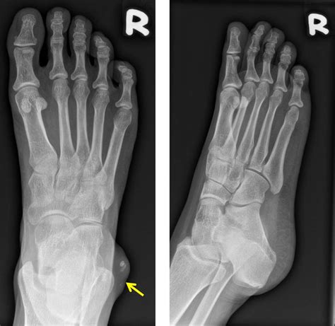 Epidermal Cyst At Ankle Radiology Cases