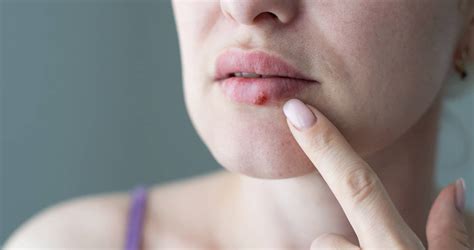 Cold Sores In Mouth