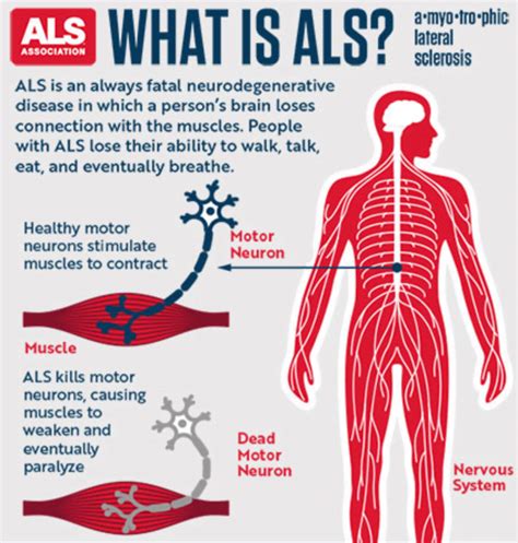 Als Amyotrophic Lateral Sclerosis Version 10 Frequency Research