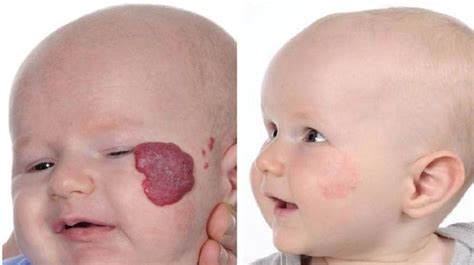 Hemangioma Treated With Propranolol Earwell Center Of Excellence
