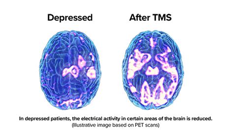 Tms Therapy How Tms Works