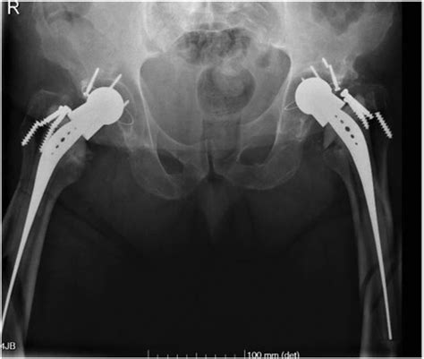 Preoperative Anteroposterior Radiograph Of The Pelvis Showing Bilateral
