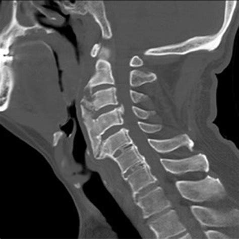 The Preoperative Ct Scan Of The Cervical Spine Reveals Continuous But