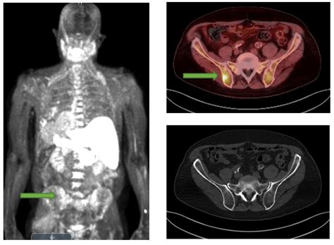 Petct For Prostate Cancer Charter Radiology