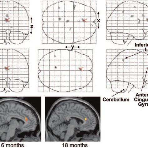 Increased Gray Matter Concentration At 6 A And 18 B Months After