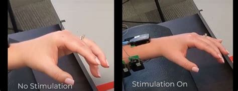 Spinal Cord Stimulation Shown To Instantly Improve Arm Mobility After