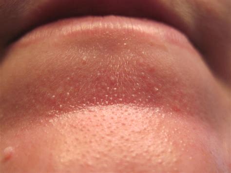 Some potential causes of dry or dehydrated skin on the face include people can treat dry skin using several different methods. Bumpy Facial Skin - Porn Xxx Game