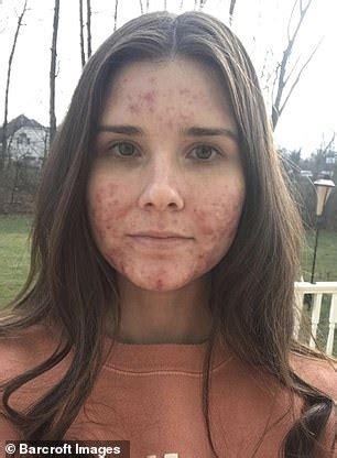 Many Photos Stylist With Severe Cystic Acne Goes Out Without Makeup For The First Time
