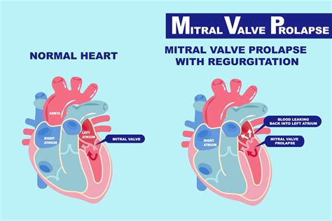 Genetic Trigger Discovered For Common Heart Problem Mitral Valve Prolapse